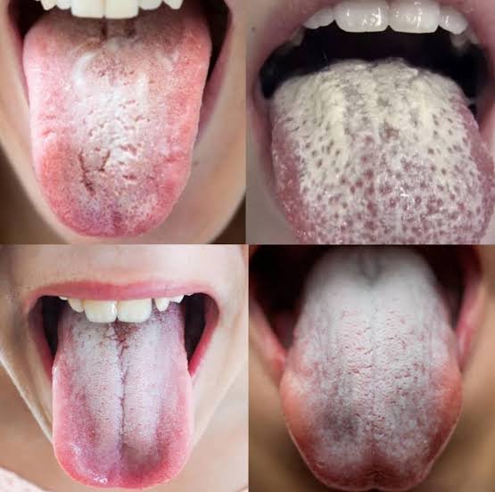 White coating on tongue